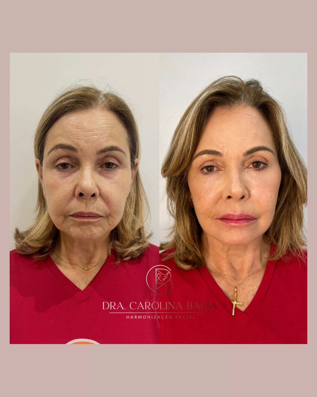 Antes e depois de harmonização facial com botox