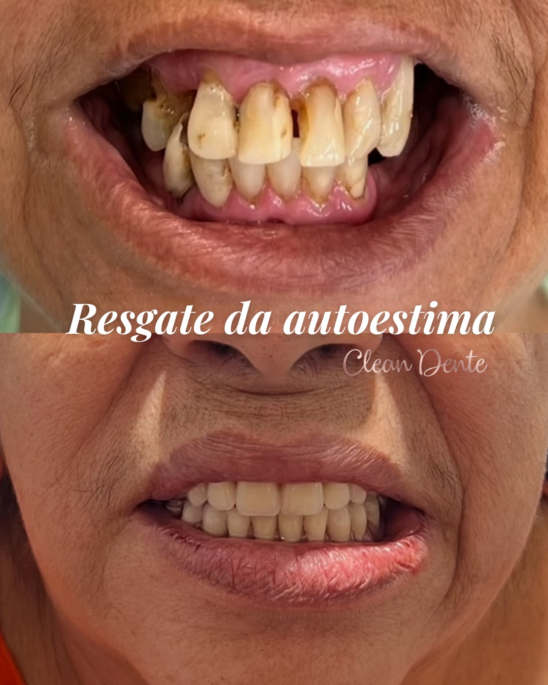Antes e depois de reabilitação do sorriso