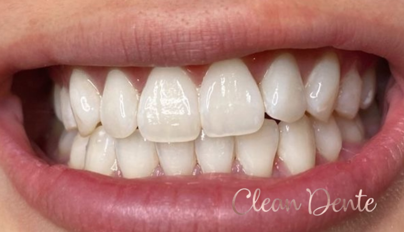 Clareamento dental