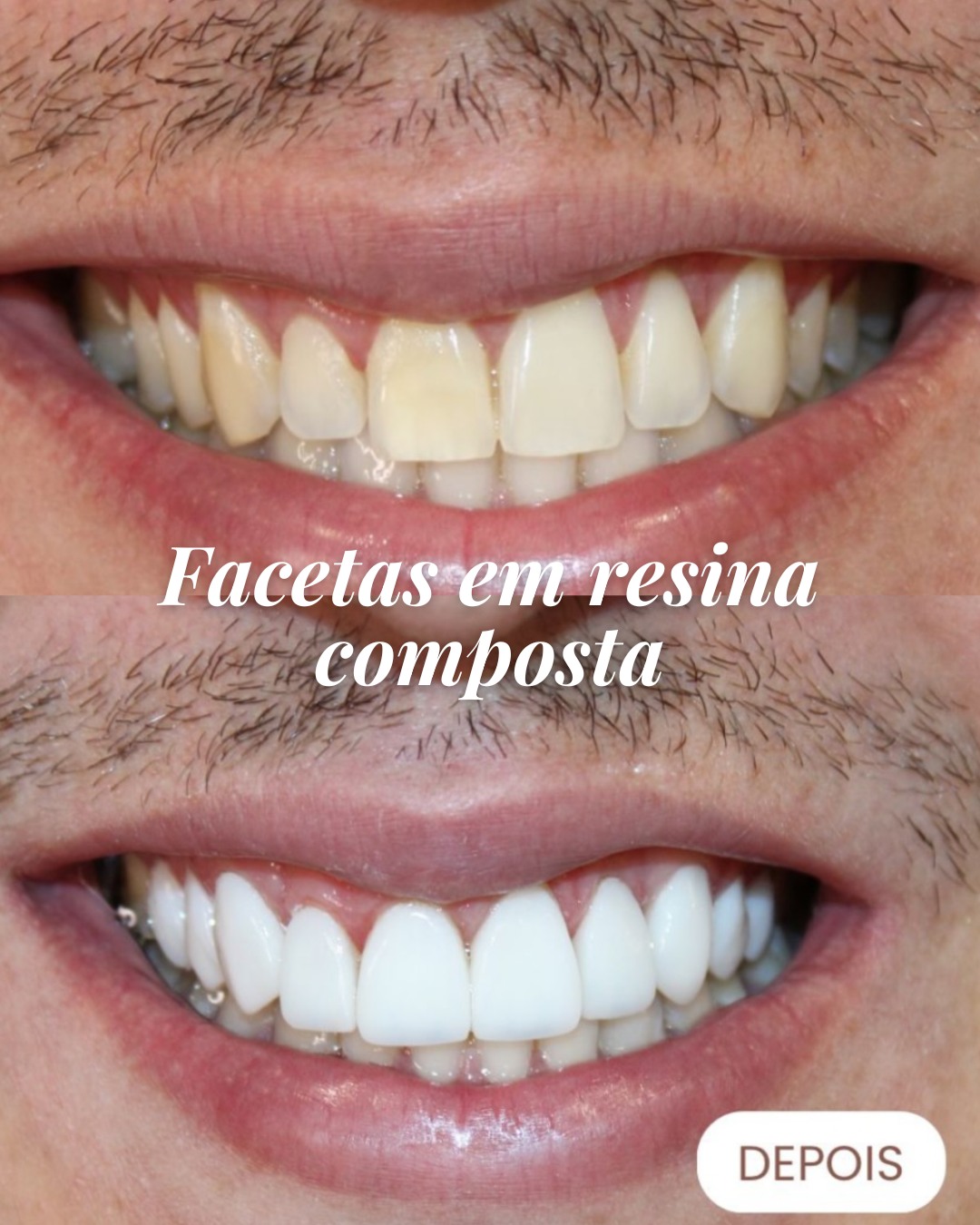 Antes e depois de facetas em resina composta