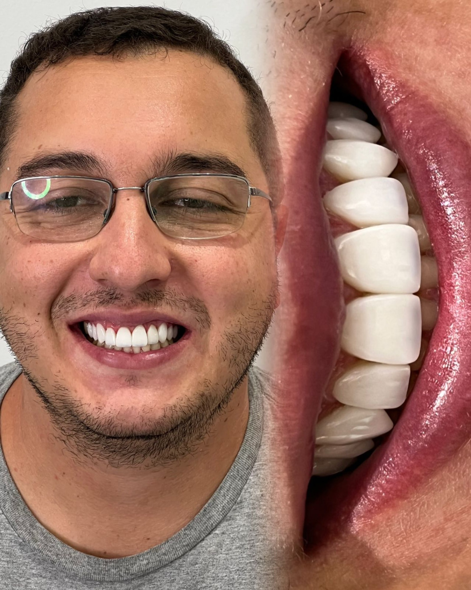 Caso real de implantes e próteses